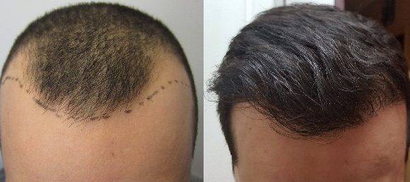 NON-Surgical Hair Transplantation